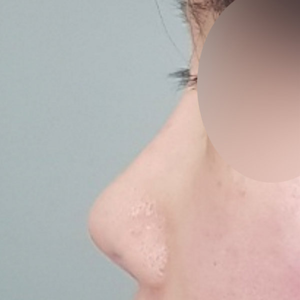 수술 전 후